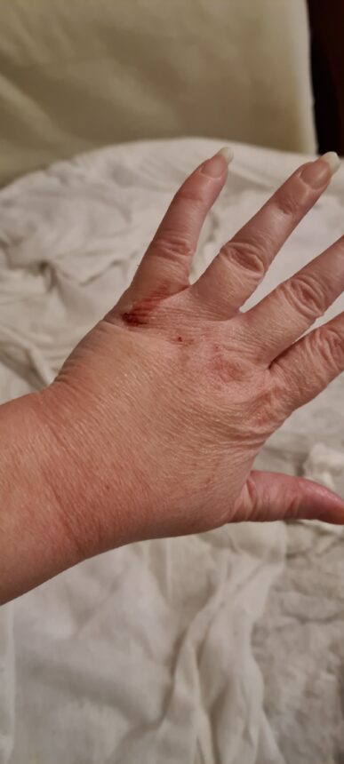 Five of the Most Common Skin Conditions - eczema
